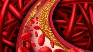 Illustration showing a blood vessel with red blood cells and a buildup of yellowish plaque, representing artery blockage or atherosclerosis—a condition often discussed when exploring natural remedies for clogged arteries.