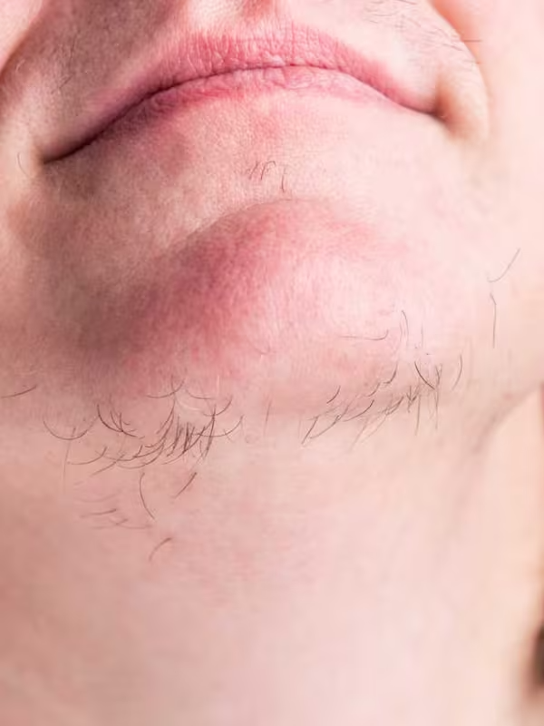 polycystic ovary syndrome, Symptoms, Causes, Diagnosis, and Treatment 