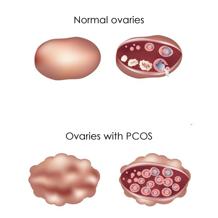 normal ovary and ovary with pcos